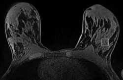 This unenhanced image shows region of interest placement in a 30-year-old...