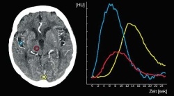 Fig. 1: Typical time/density curves after injection of a contrast mediumbolus...