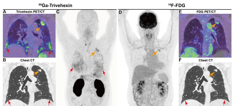 PET/CT imaging using Ga-68-Trivehexin (A,B,C) and F-18-FGD (D, E, F) of a...