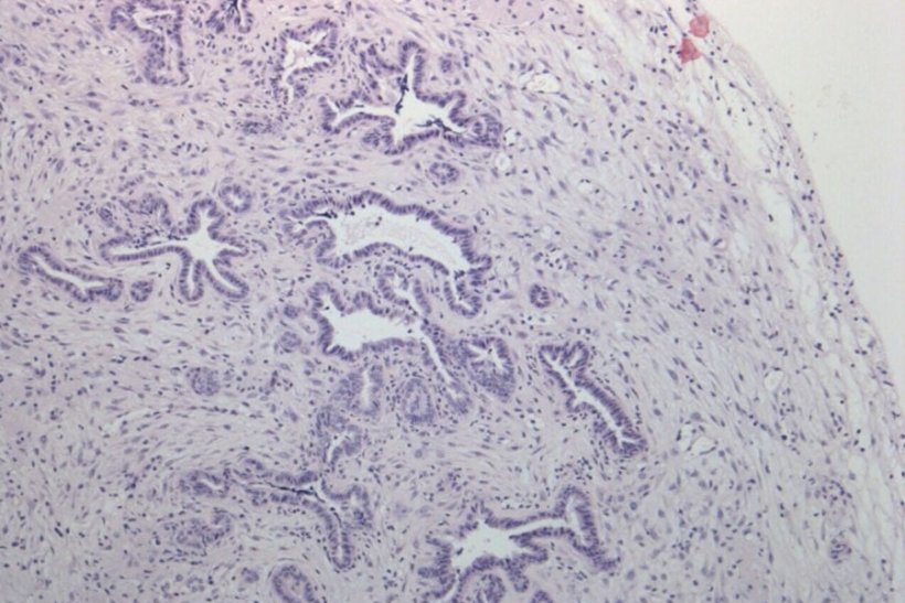 Pancreatic tumor cells and their surrounding stroma