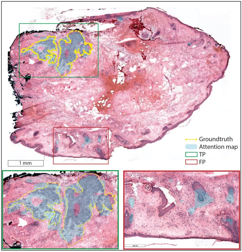 Tissue sections of skin with basal cell carcinoma, overlaid with AI-generated...