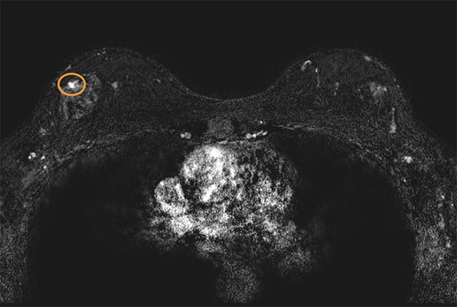 This screening MRI detected a very small cancer (circled) in the patients breast