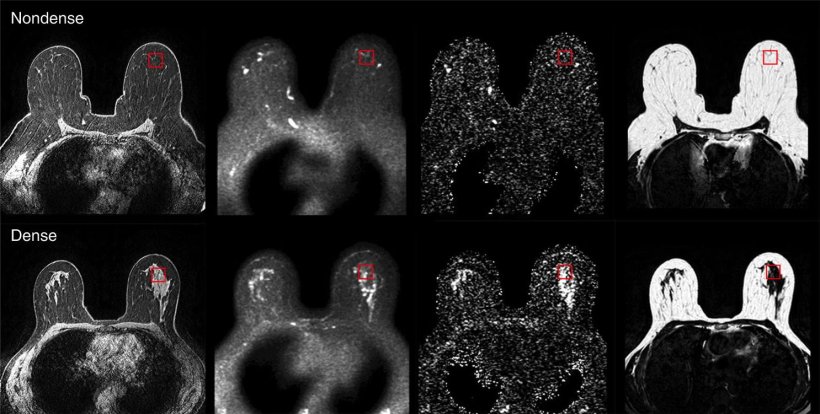 Images from left to right; T1-weighted High Resolution Isotropic Volume...