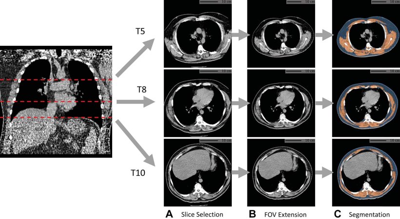 Example of fully automated body composition assessment in the lung cancer...