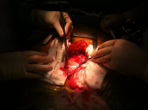 heart operation